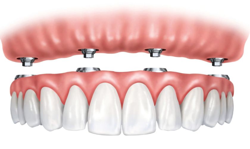 Implant-Supported Dentures