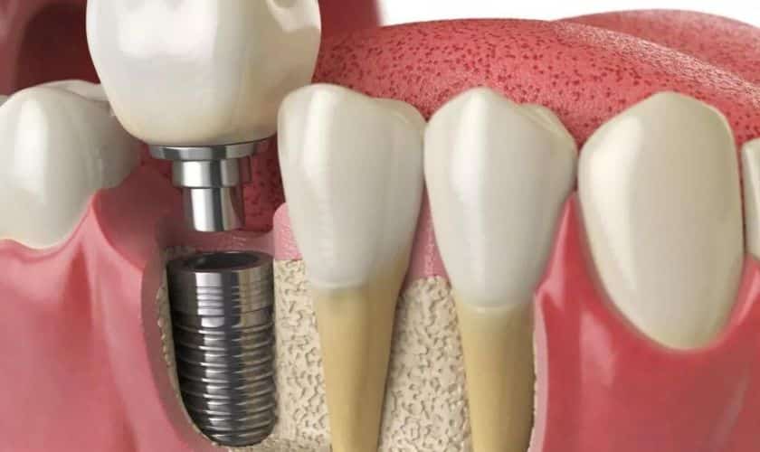 Dental Implant