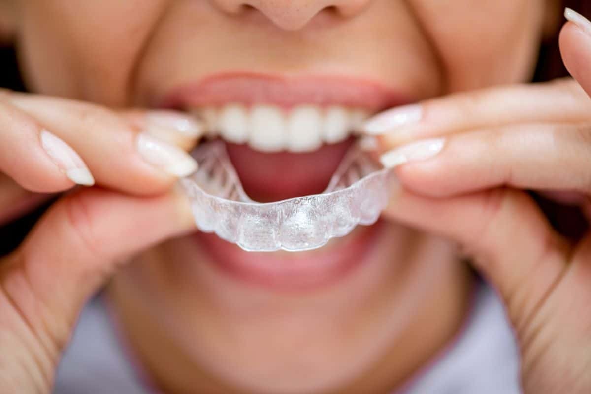 Featured image for “Adult Braces Gainesville: How to Prepare for Orthodontic Treatment”